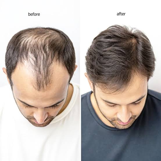 Before and after hair transplant result - Case 1