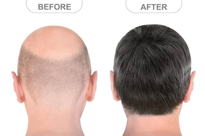 Before and after hair transplant result - Case 2