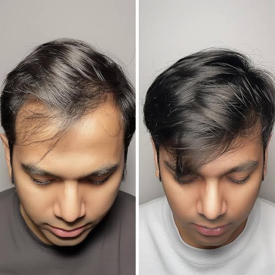 Before and after hair transplant result - Case 3